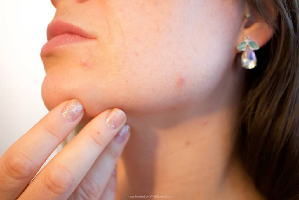 Acne - Pimples - Skin Problems - Diet