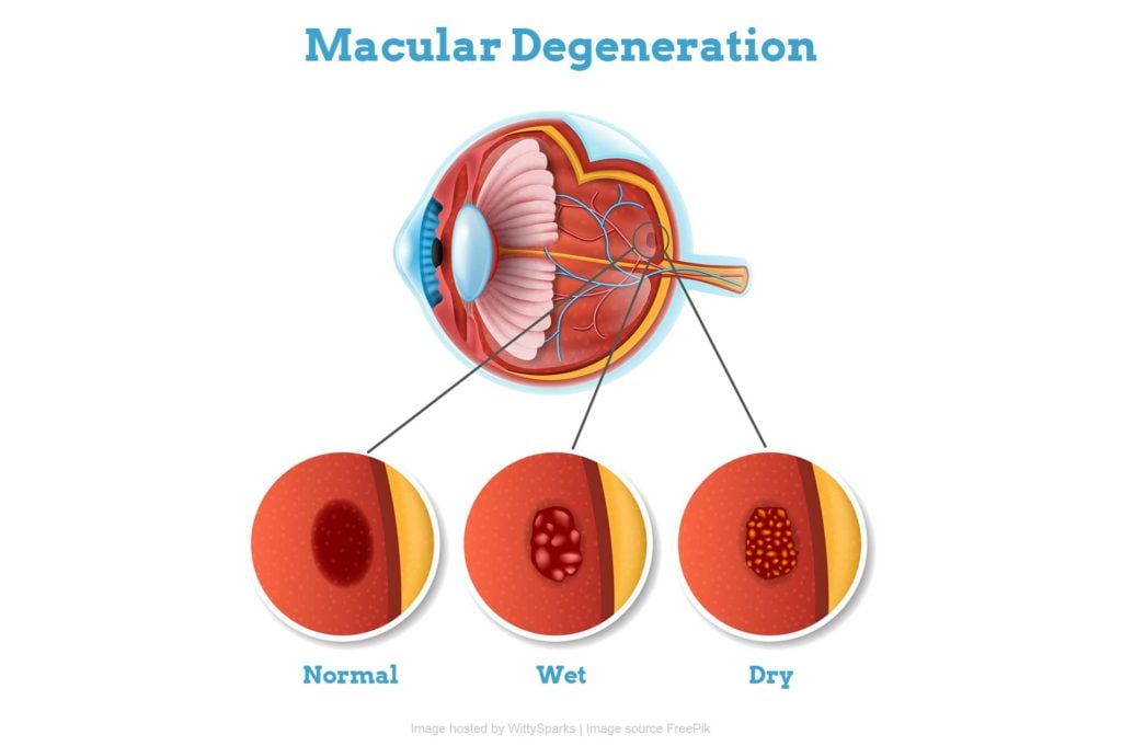 Age-related Macular Degeneration