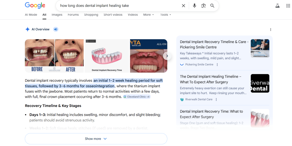 A Complete AEO Guide To Dominate the Answer Engine Citations! 5 Google search results with AI Overview explaining dental implant healing time
